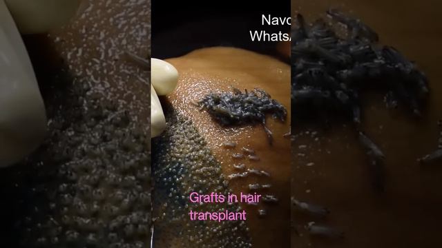 9416500112,  HD Live Hair Transplant Implantation | Hair Graft Looks