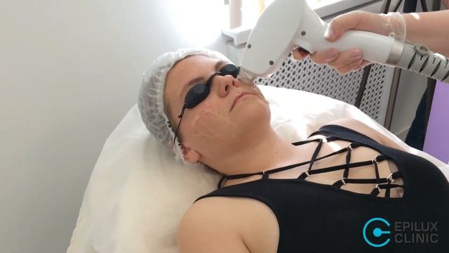 Лазерная эпиляция щек и скул и лица полностью смотреть онлайн