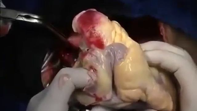 Хирурги показали, как происходит пересадка сердца смотреть онлайн