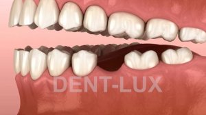 Что происходит после удаления зуба?