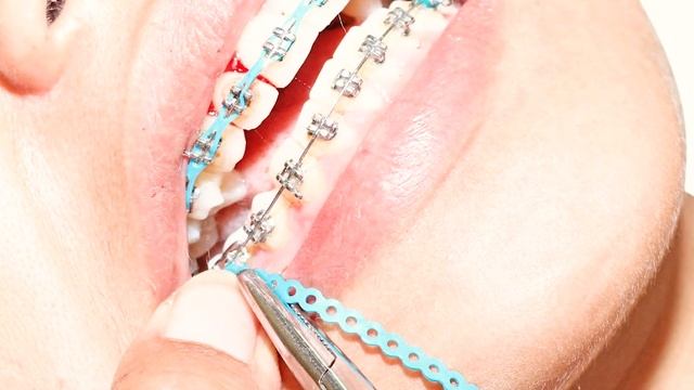 БРЕКЕТЫ | СКОЛЬКО СТОЯТ, ДО ПОСЛЕ, ВИДЫ БРЕКЕТОВ смотреть онлайн