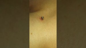 Установка микродермала, обучение