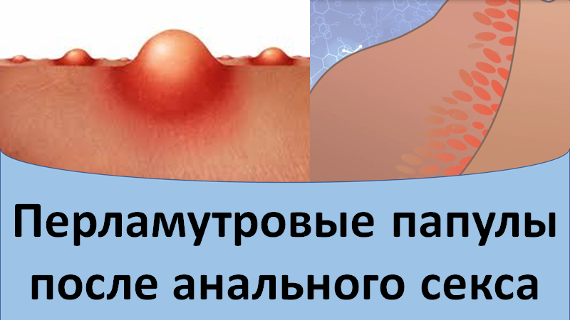 Перламутровые папулы после анального секса смотреть онлайн
