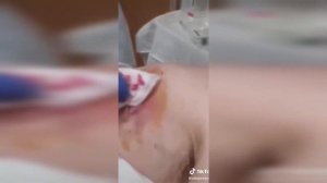 подборка выдавливания прыщей 31 II выдавливание прыщей