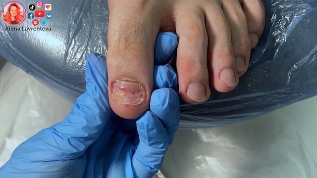 Отошел ноготь на ноге / Натоптыши на пальцах ног смотреть онлайн