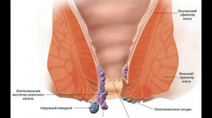 Геморрой — признаки и причины, лечение заболевания
