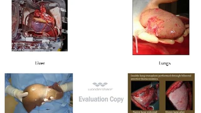 Organ Donation power point смотреть онлайн