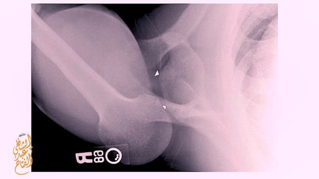 01 Shoulder injuries: Intro смотреть онлайн
