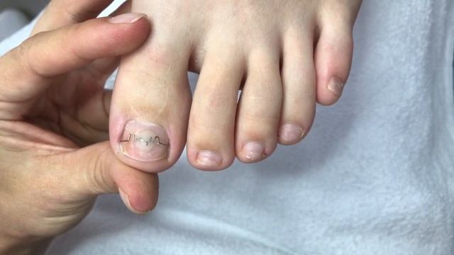 Титановая нить - Подолог