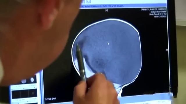 Вы не поверите как выглядит этот малыш спустя 20 месяцев. Это настоящее чудо! смотреть онлайн