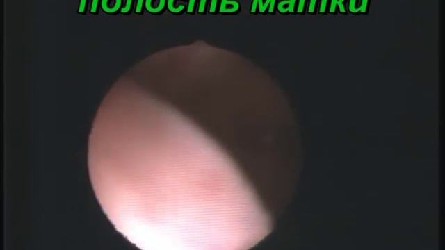 Гистероскопия у девственницы. Полипы эндометрия. смотреть онлайн