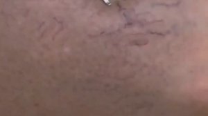 Удаление сосудов на лице и теле в Калуге