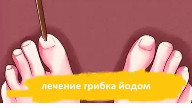 Использование йода от Грибка Ногтей на ногах! Народные рецепты смотреть онлайн