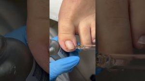 Эфир 1.  Околоногтевой кератоз