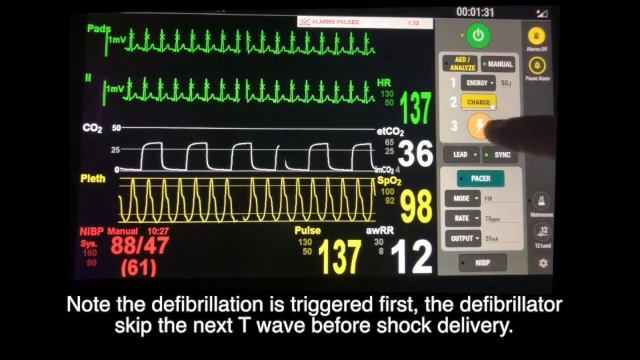 Introduction of virtual defibrillator & pacer with LLEAP смотреть онлайн