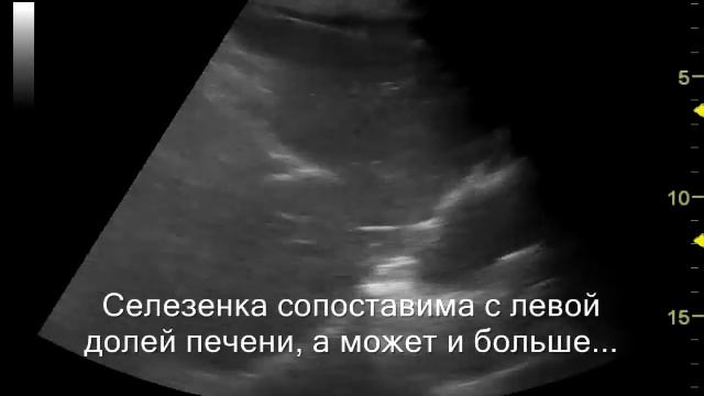 Гигантская селезенка смотреть онлайн
