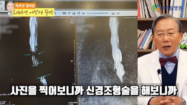 Eng, Ru cc)척추관 협착증 오래두면 어떻게 될까?/What happen if spinal stenosis left untreated? смотреть онлайн