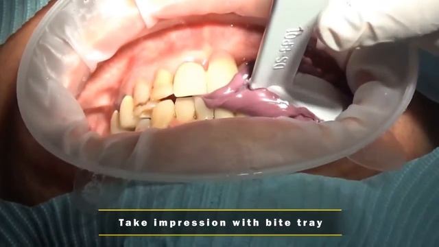 [DENTIS Implant] How to use of HI SCAN Coping смотреть онлайн