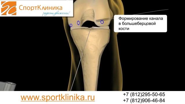 Повреждение передней крестообразной связки, ПКС смотреть онлайн