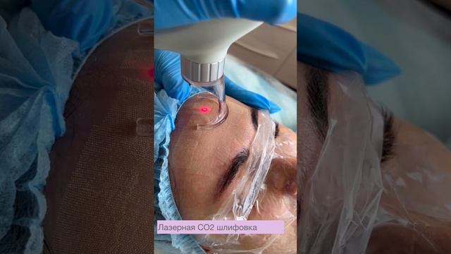 Лазерное омоложение, шлифовка кожи на аппарате FRAXIS #аппаратнаякосметология #омоложение смотреть онлайн