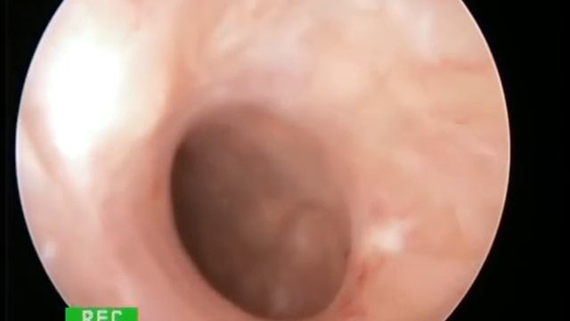 vaginoscopy pin hole cervix смотреть онлайн