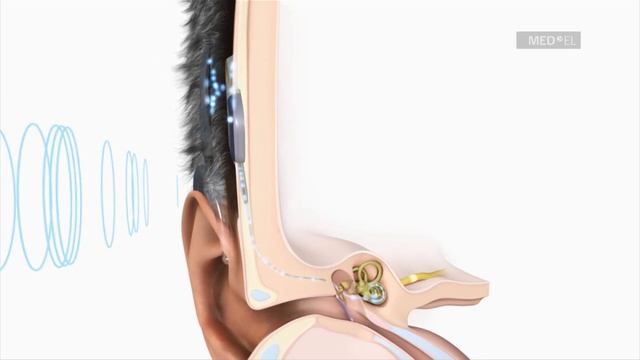 The MAESTRO Cochlear Implant System from MED-EL with OPUS2 XS | INT смотреть онлайн