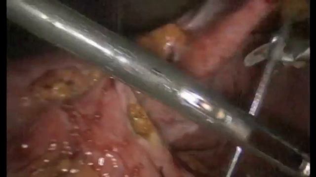 Laparoscopy-assisted transgastric ERCP after Roux-en-Y gastric bypass смотреть онлайн