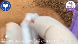 Удаление и выдавливание фурункула. Выдавливание большой чёрной точки. Чистка лица