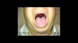 Инсульт. Дисфагия. Упражнения для восстановления глотания