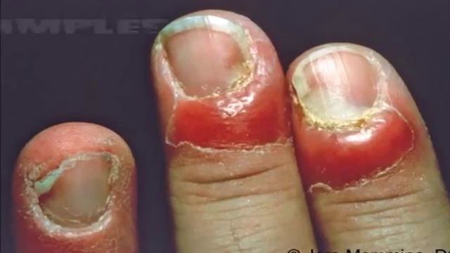 Popping Nail Infections! What is a Paronychia? смотреть онлайн