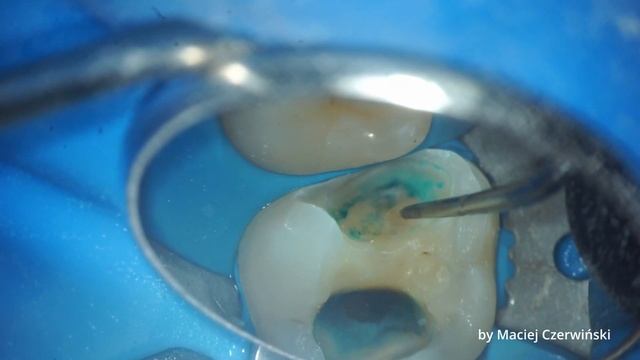 Guided Caries Preparation With Composite Shield