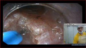 Пероральная эндоскопическая миотомия при ахалазии кардии