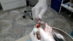 Удаление ногтя после травмы
