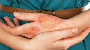 ✅ Первая помощь при ожогах в домашних условиях.Первая помощь при ожогах.Первая помощь при ожоге кож