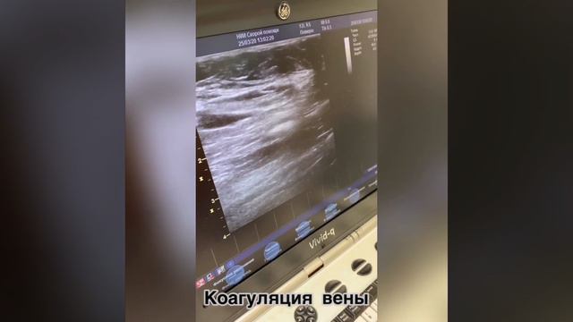 Клинический случай №3: Эндовенозная лазерная коагуляция большой подкожной вены смотреть онлайн