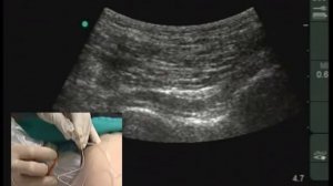 Проводниковая анестезия седалищного нерва