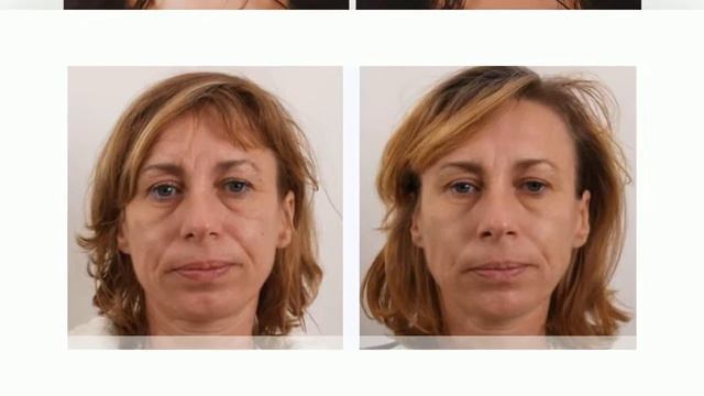 Non Surgical Face Lift смотреть онлайн