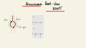 Наджелудочковые тахикардии. Как отличить АВУРТ от АВРТ. ЭКГ диагностика.