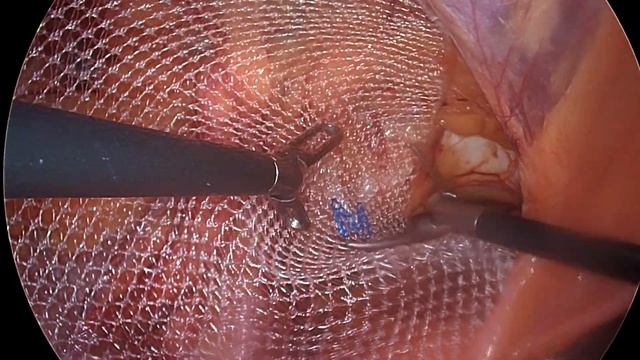 tapp left laparoscopic indirect hernia смотреть онлайн