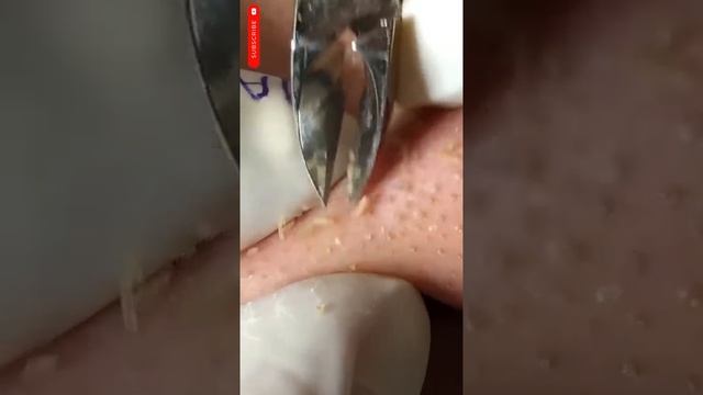 Black Heads Remove Most Satisfying ASMR Relaxing #blackheads #asmr #satisfying