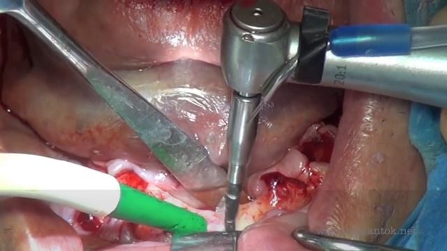 Immediate fixed Rehabilitation full arch with Toronto bridge Nobel Biocare dr.Giampiero Ciabattoni смотреть онлайн