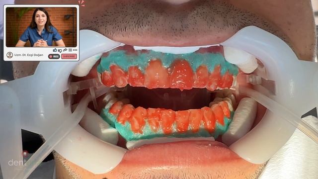 Diş Beyazlatma İşlemi Nasıl Yapılır ? | " Canlı Canlı İşlemi İzleyin ! " - Uzm. Dt. Ezgi Doğan смотреть онлайн