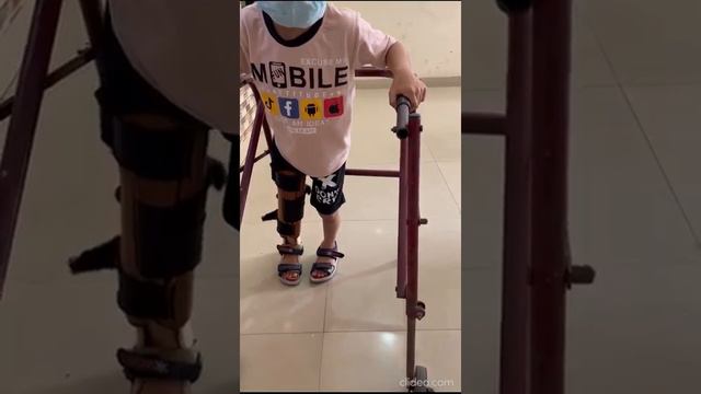 Cerebral Palsy With Spastic Hemiplegia Right Side (GMFCS-3/5)