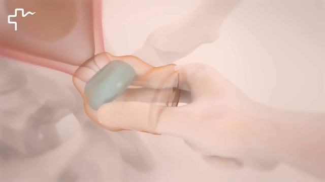 Введение акушерского пессария доктора Арабин Учебный фильм смотреть онлайн