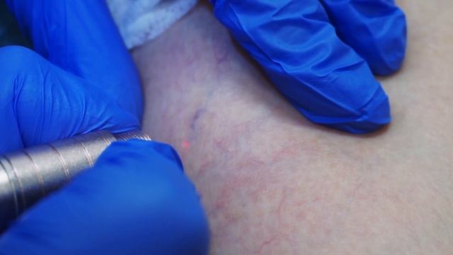 Удаление Сосудистой Сетки На Ногах смотреть онлайн