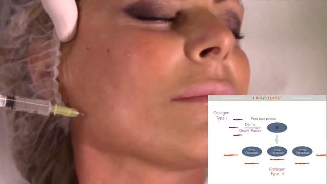 Linerase Collagen Treatment