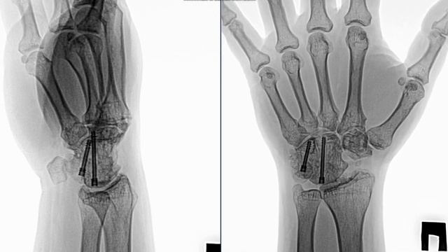 X-ray of the wrist | Xray | Radiological Survey Images #X-ray смотреть онлайн
