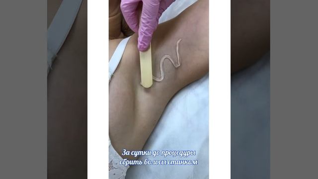 Лазерная эпиляция смотреть онлайн