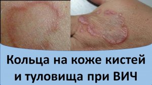 Кольца на коже и туловище при вич