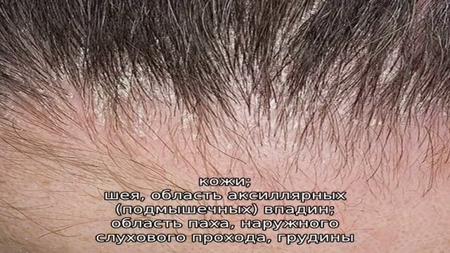 Средство 'Мустела' для ухода за кожей головы смотреть онлайн